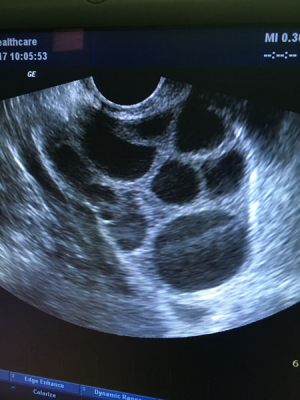 Εξωσωματική Γονιμοποίηση - Αθανάσιος Διακουμάκος